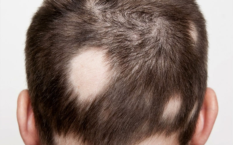 alopecia-areata