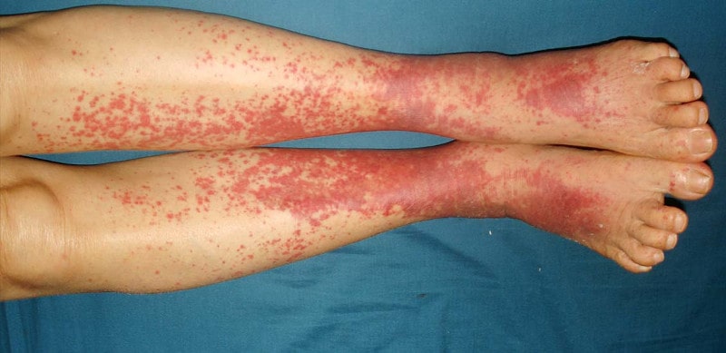 vasculitis