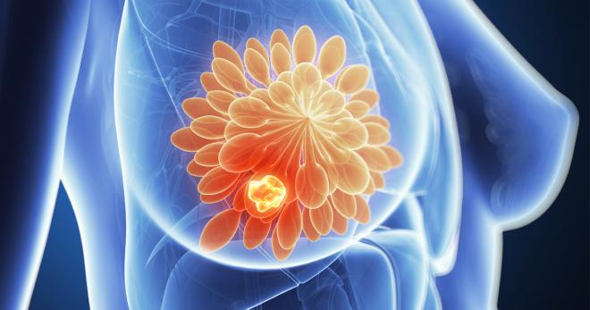 cáncer de seno