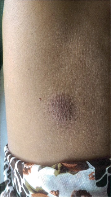 MELIOIDOSIS EN COLOMBIA