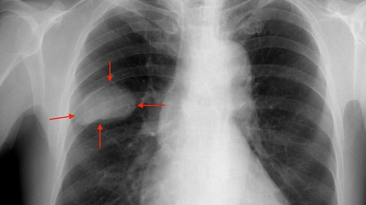 ANCESTRÍA EN CÁNCER EN AMÉRICA LATINA