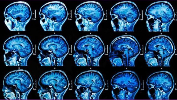 covid-19-neurología