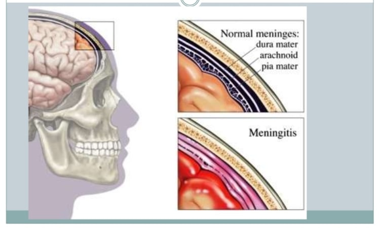 meningitis-bacteriana-aguda
