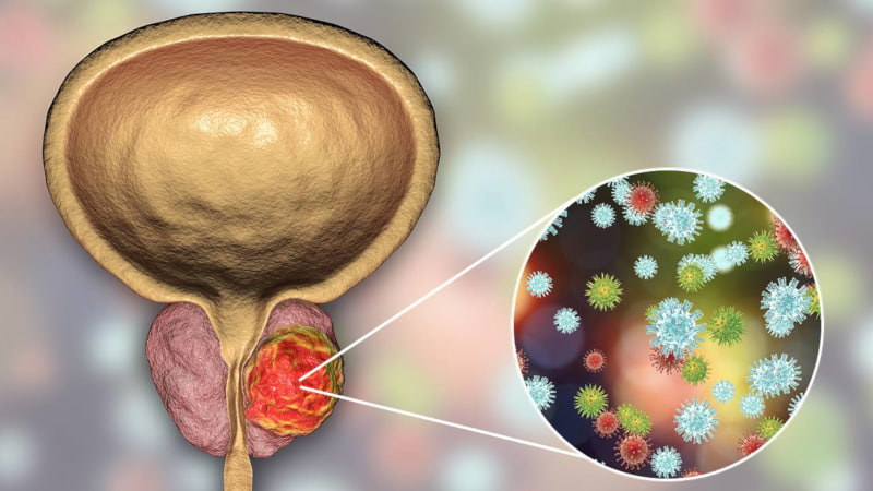 cancer-de-prostata