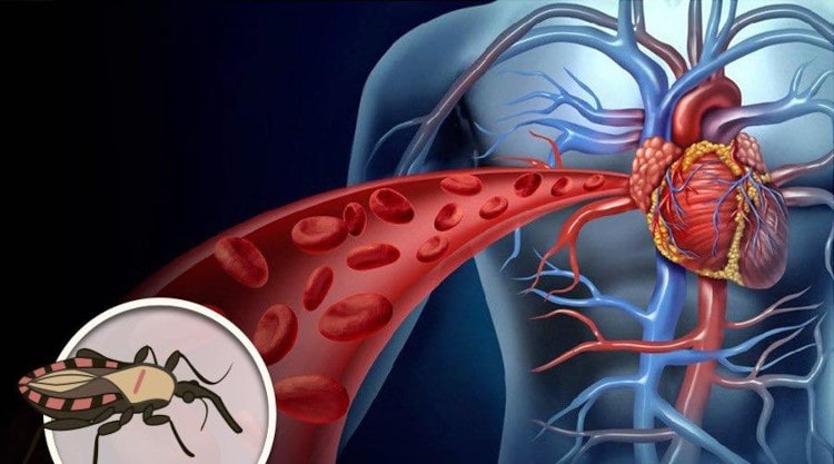 Cardiomiopatía chagásica en Colombia. Una historia para contar con el corazón.