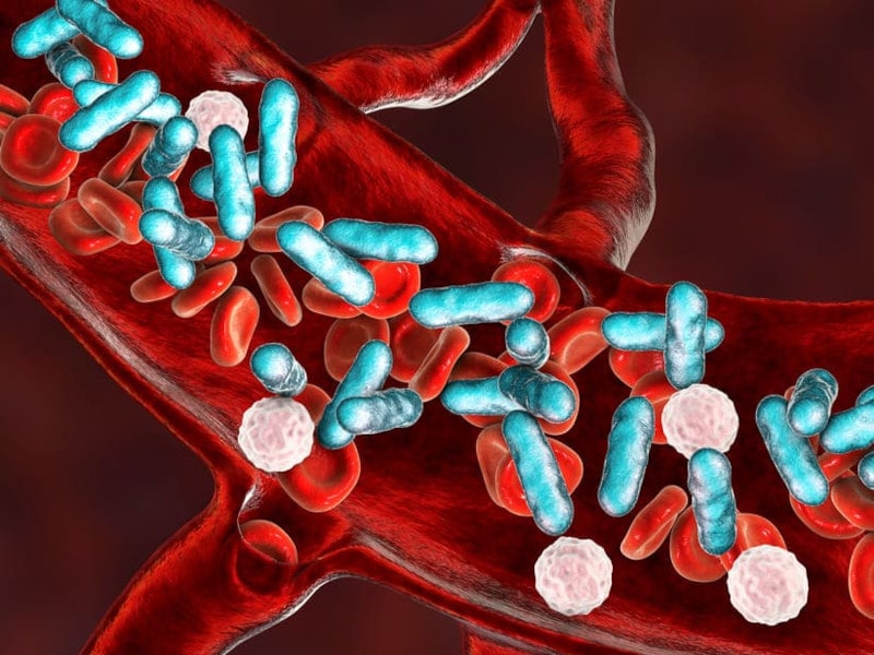 Sepsis
