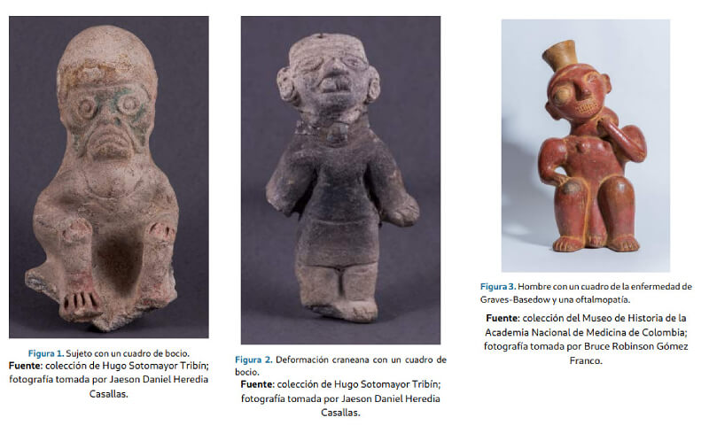 Paleopatología endocrinológica y urogenital en arte prehispanico-I