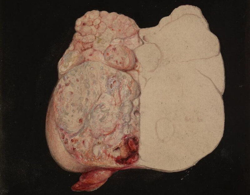Sarcoma-Godart Thomas