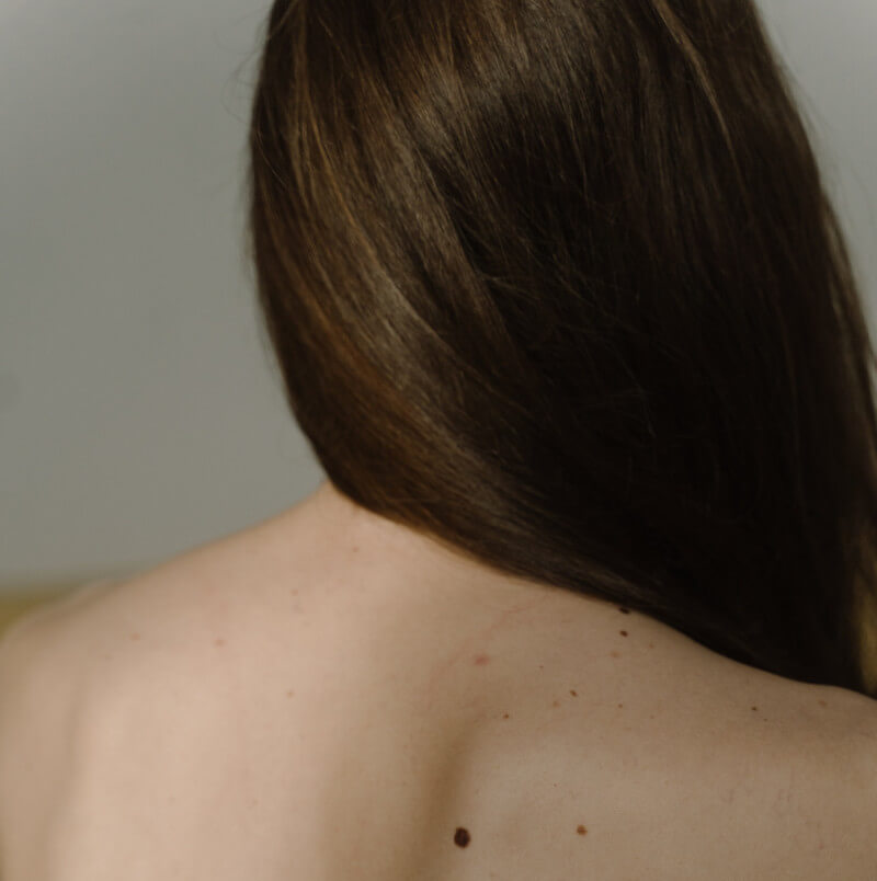 piel-melanoma-lunares