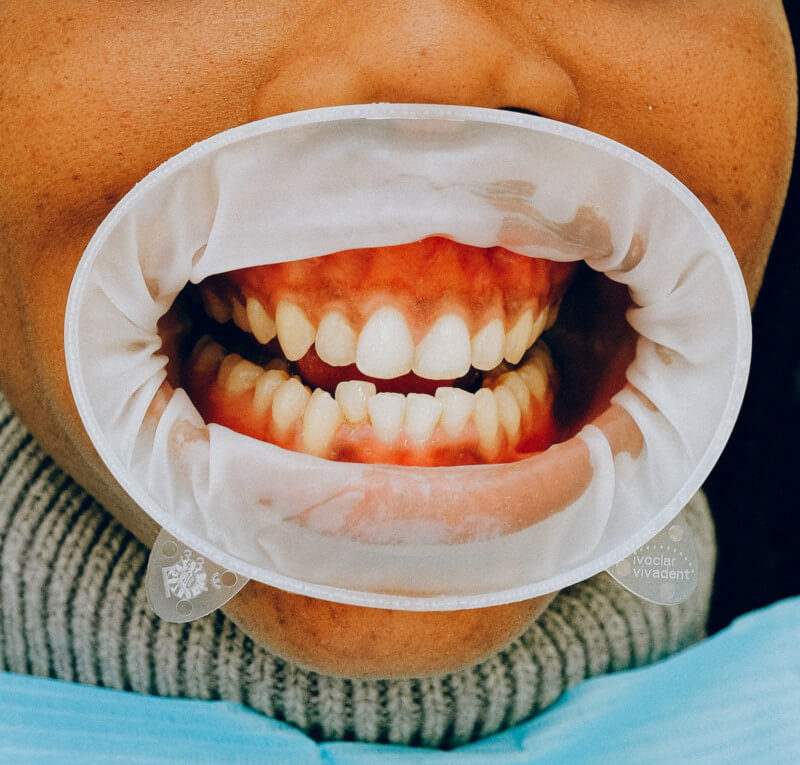 periodontitis-dientes-encías