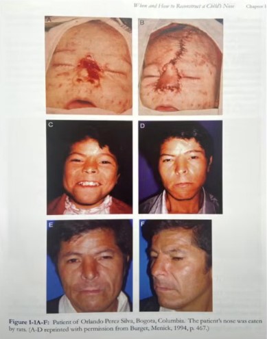 reconstrucción nariz en bebé