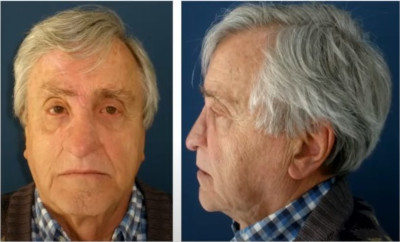 resultado reconstrucción nasal total