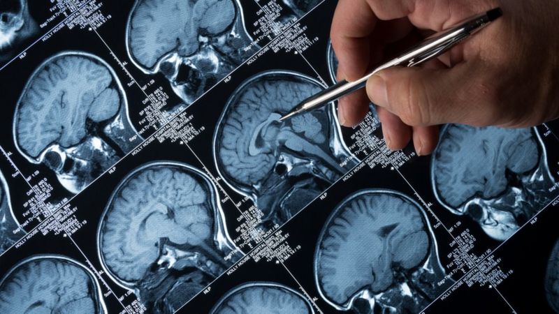 resistencia-al-Alzheimer-Colombia