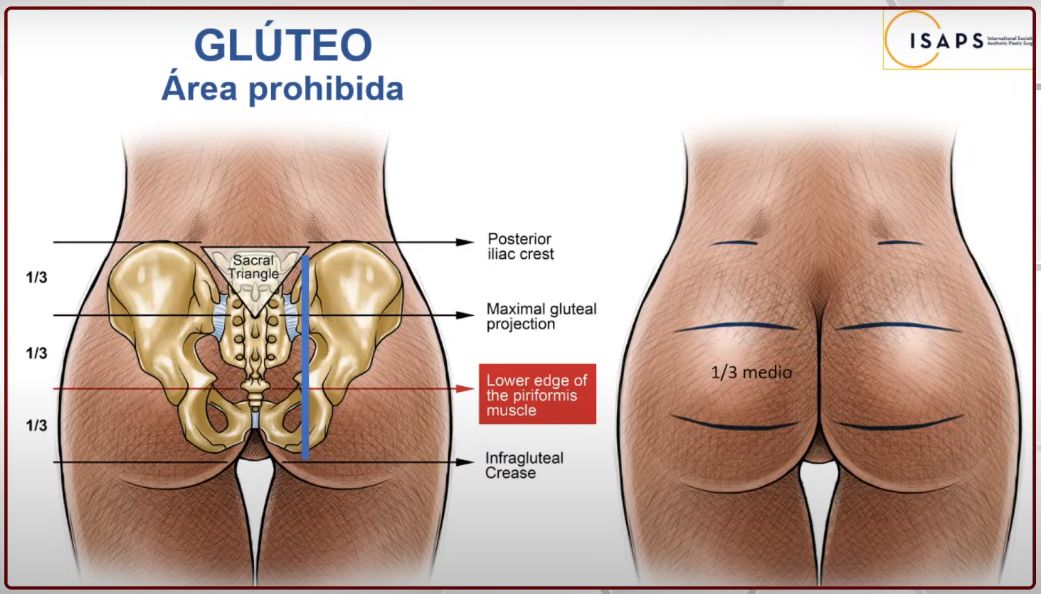 area prohibida-lipoinyección