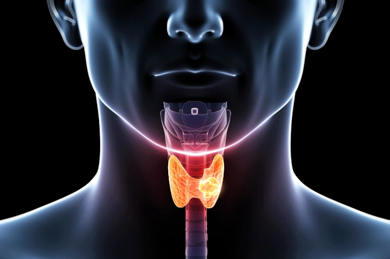 cancer-de-tiroides