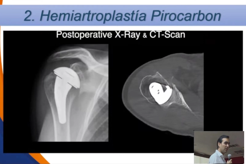 cirugia_hombro_protesis_pirocarbono