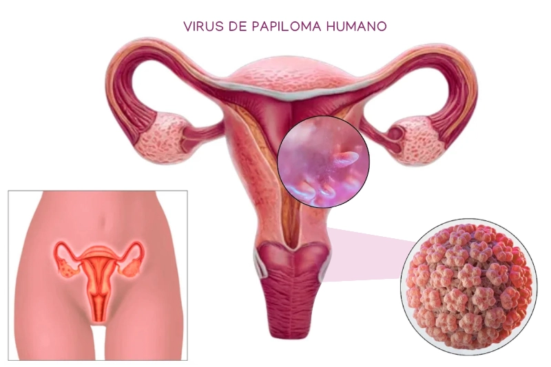 Virus_de_papiloma_humano