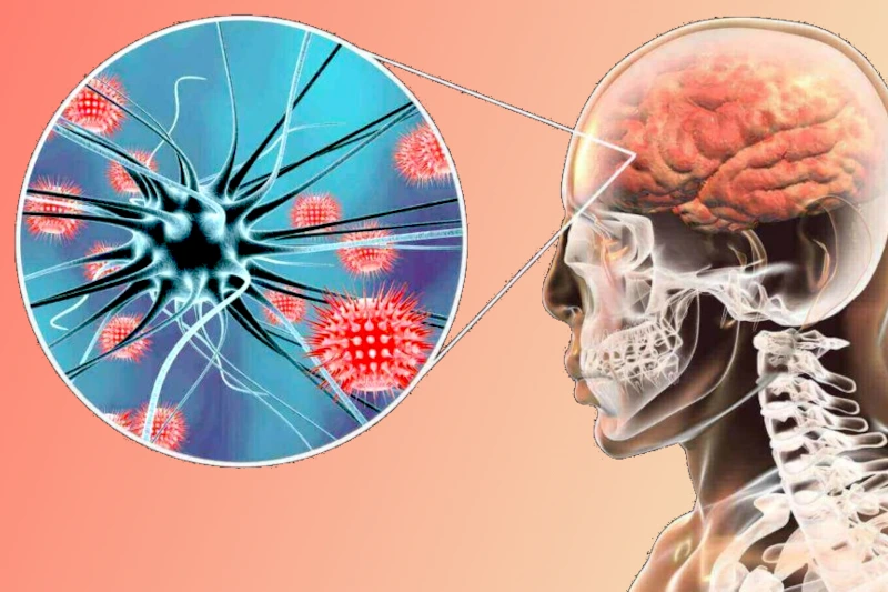 meningitis