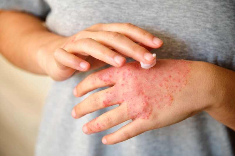 dermatitis_atopica