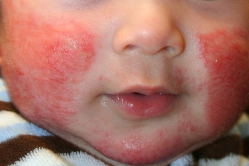 dermatitis_atopica_bebes