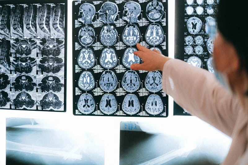 accidentes_cerebro_vasculares