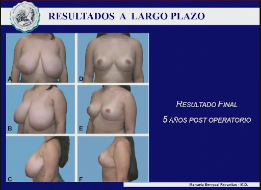 Cirugia_gigantomastia_Dra.Manuela_Berrocal