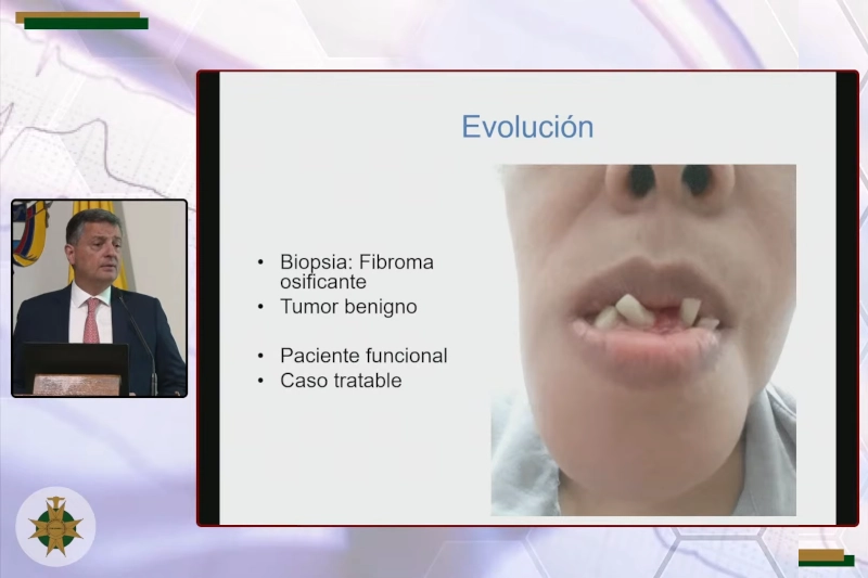 fibroma_osificante